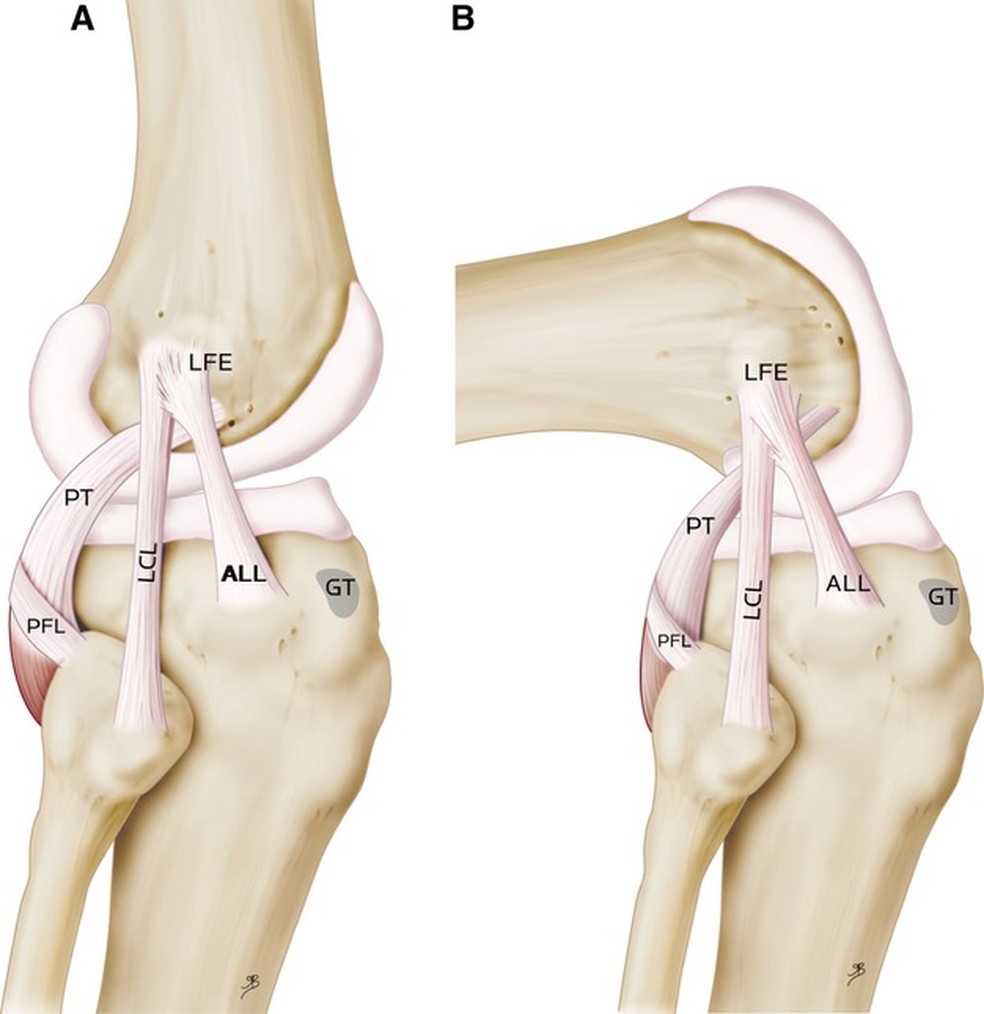 Ligamento antero-lateral no joelho (representado na imagem pelas letras ALL) — Foto: Reprodução