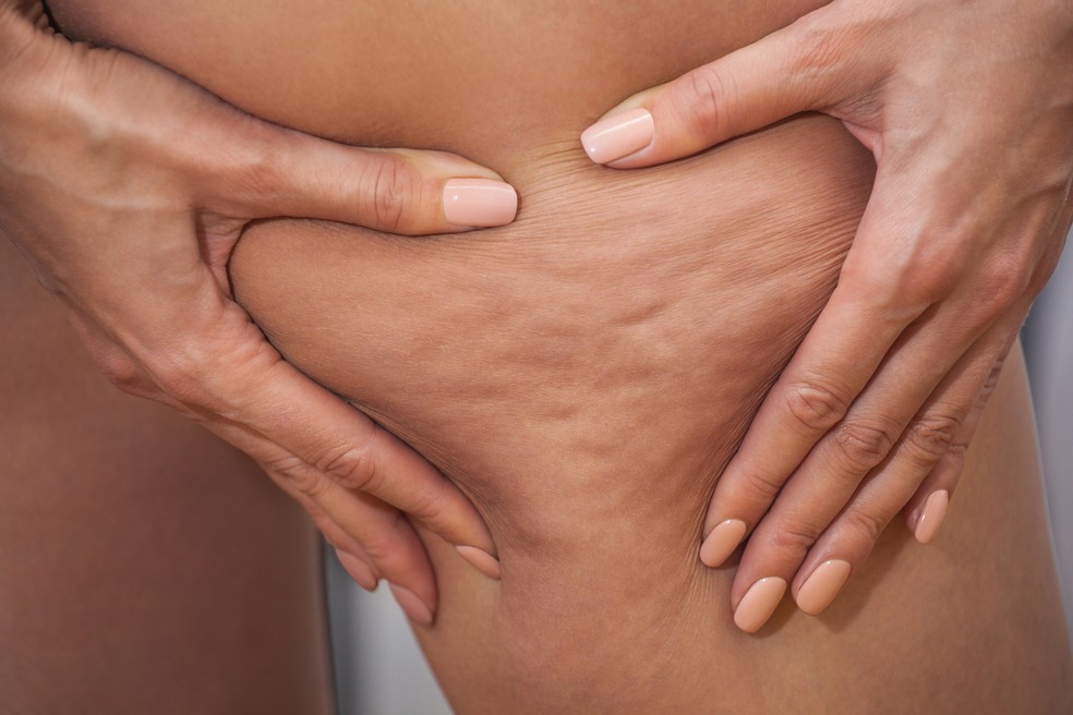 De acordo com a Sociedade Brasileira de Dermatologia (SBD), as celulites afetam cerca de 95% das mulheres após a puberdade — Foto: iStock
