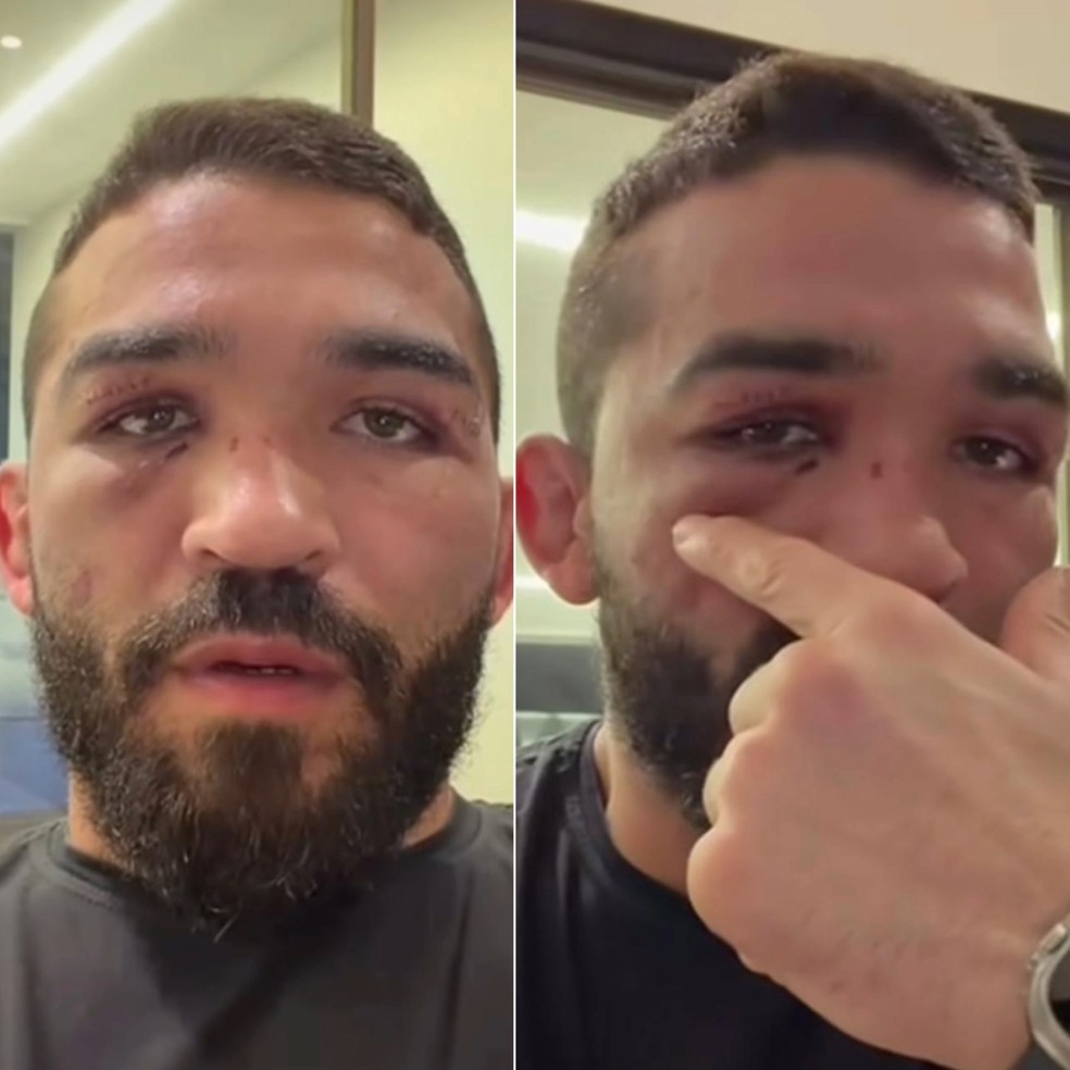 Patrício Pitbull revela fratura na órbita ocular e detalha impacto do golpe de Aaron Pico — Foto: Reprodução