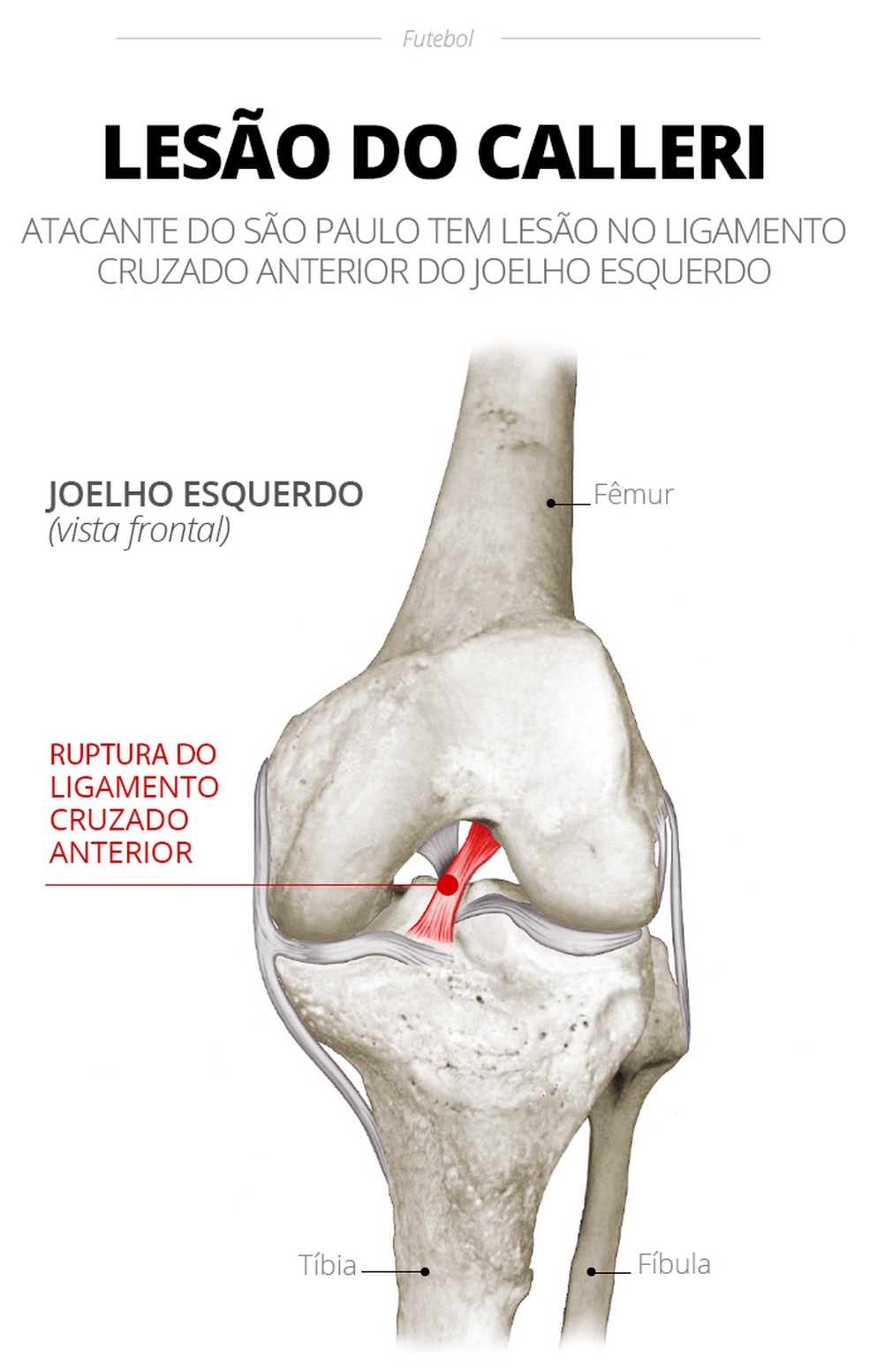 A lesão no joelho esquerdo de Calleri deve tirar o jogador de combate por até nove meses — Foto: ge