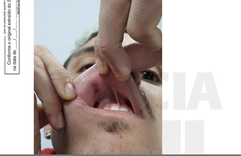 Ferimento de Pedro na boca após soco do preparador físico do Flamengo — Foto: Reprodução