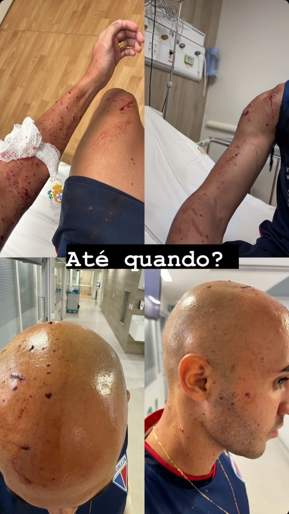 Dudu ferido por estilhaços em chegada do Fortaleza — Foto: Reprodução/Instagram