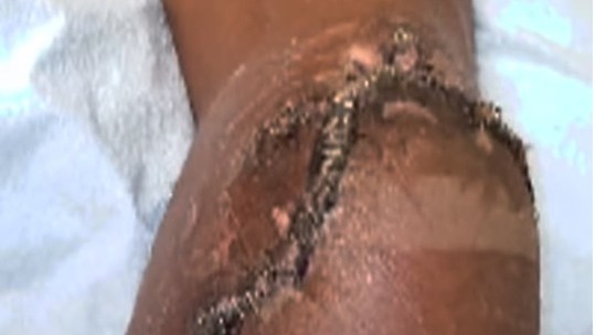 Surfista brasileiro que sofreu acidente nos EUA passa por sutura nas pernas com 95 grampos