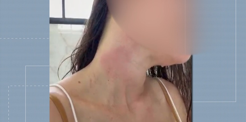 Mulher mostra marcas de agressão do ex-jogador Jadson — Foto: Reprodução/RPC