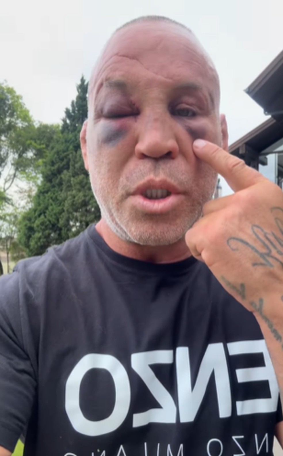 Wanderlei Silva mostra hematomas sofridos após confusão no Spaten Fight Night — Foto: Reprodução/Instagram