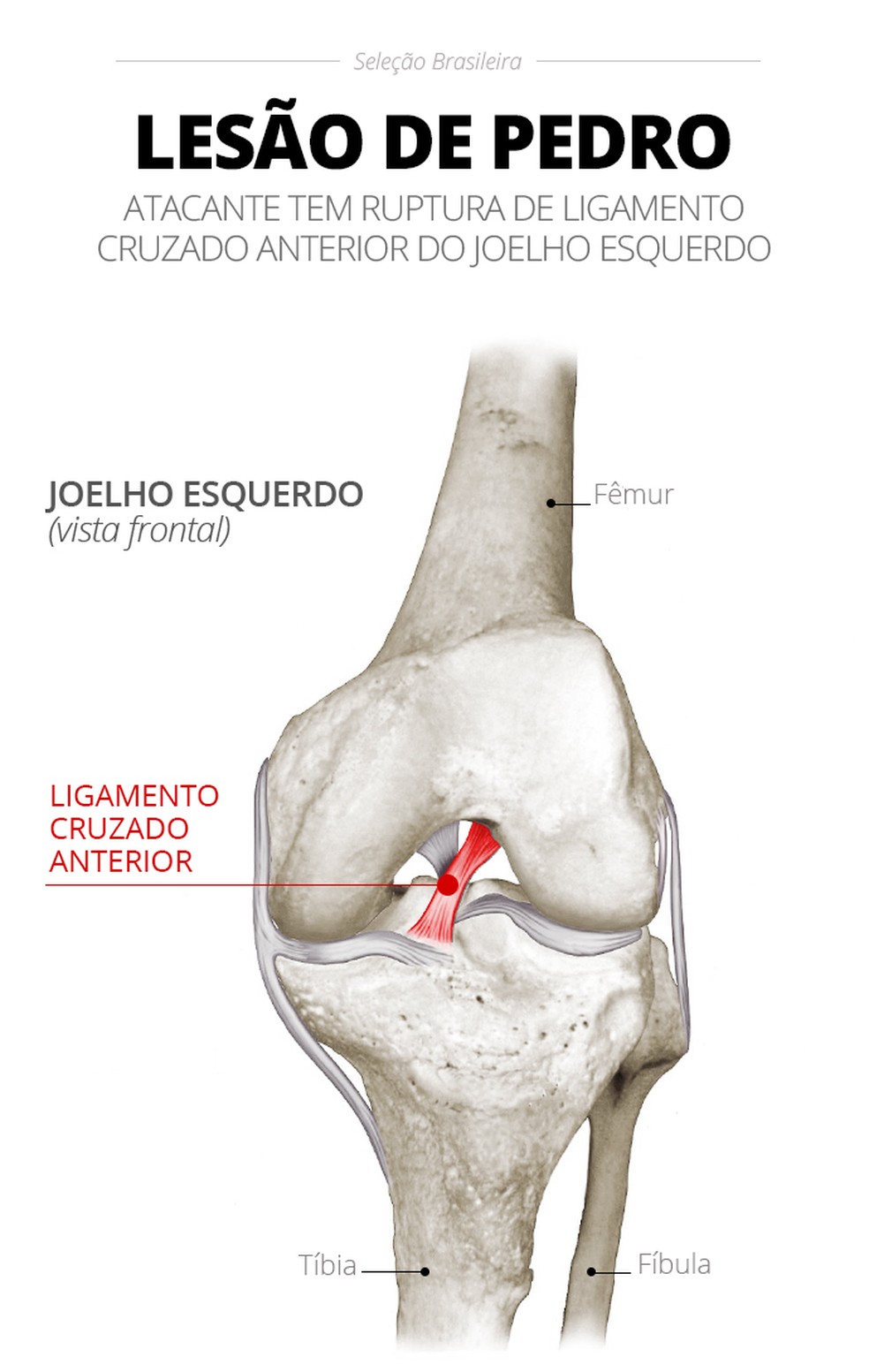 Confira gr�fico da les�o de Pedro � Foto: Editoria de arte/ge