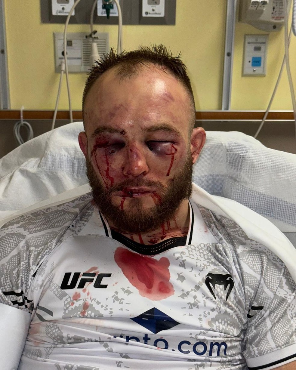 Mateusz Rebecki mostra o rosto feriado após luta contra Carlos Diego Ferreira — Foto: Reprodução/Instagram