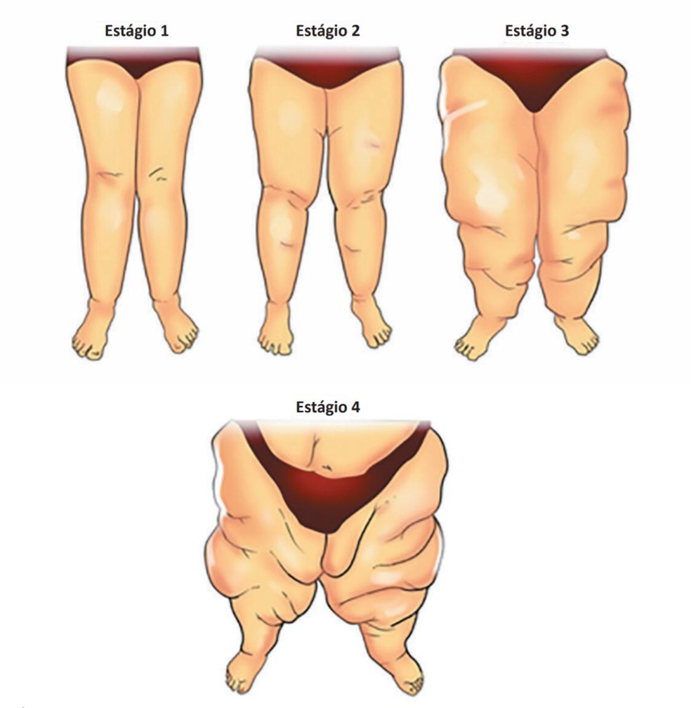 Lipedema: Como reduzir a gordura das pernas - AngioLife