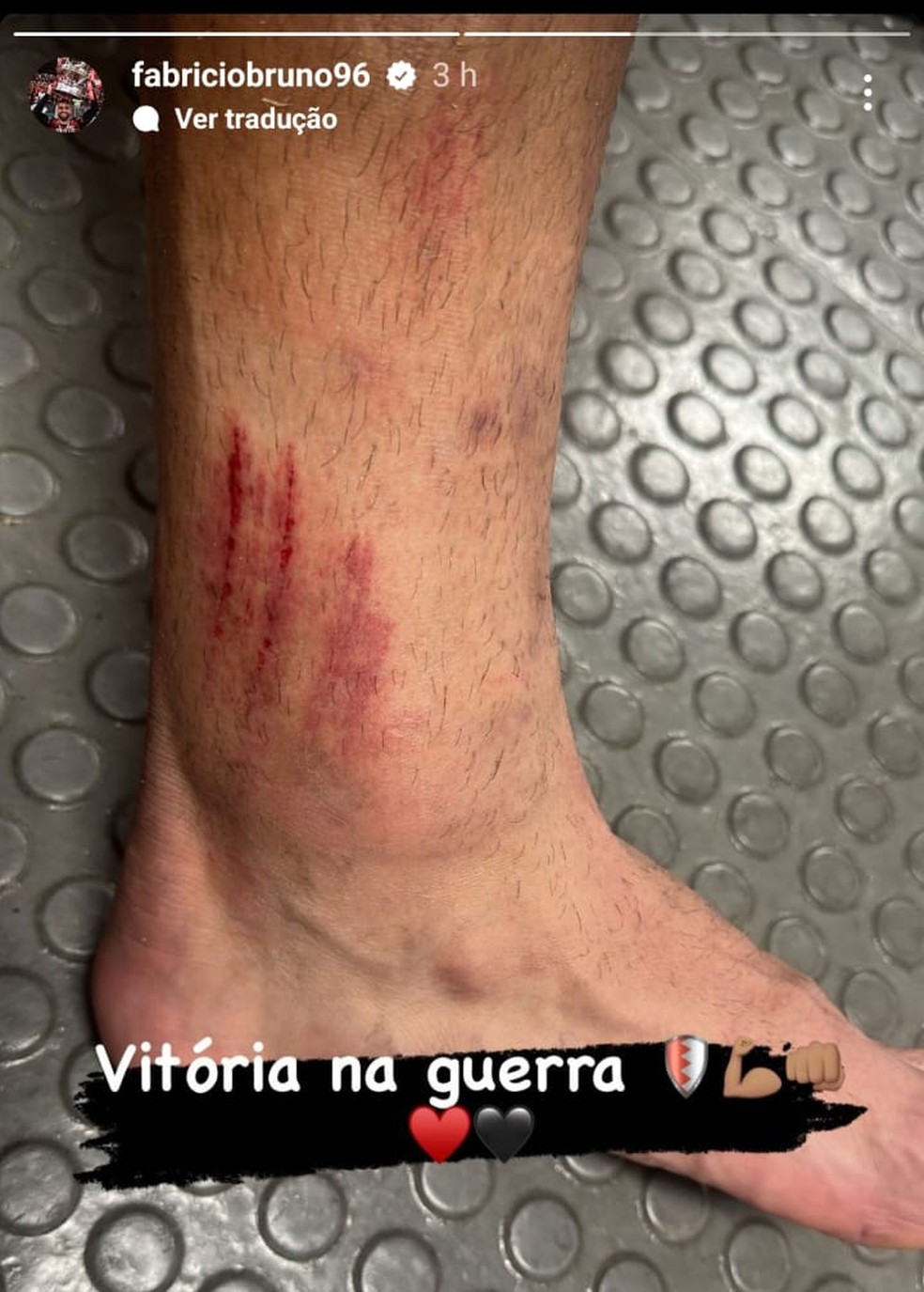 Tornozelo de Fabrício Bruno, do Flamengo, após vitória contra o Vasco — Foto: Reprodução