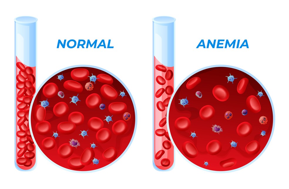 Glóbulos vermelhos baixos: o que significa? - Oncocenter