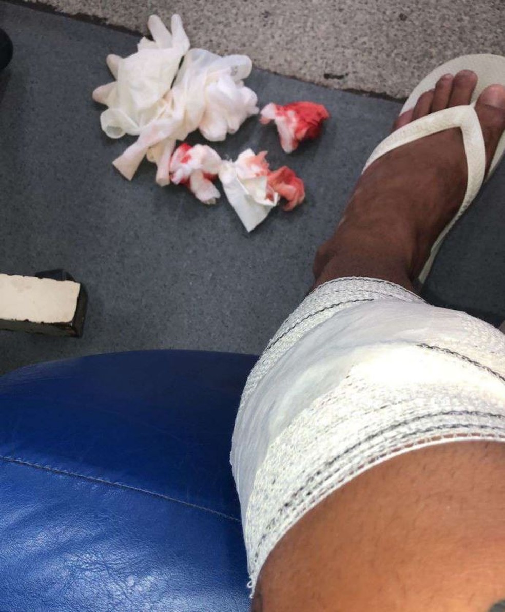 Kelvin, do Bangu, mostra o joelho esquerdo após cirurgia em 2019 — Foto: Arquivo Pessoal