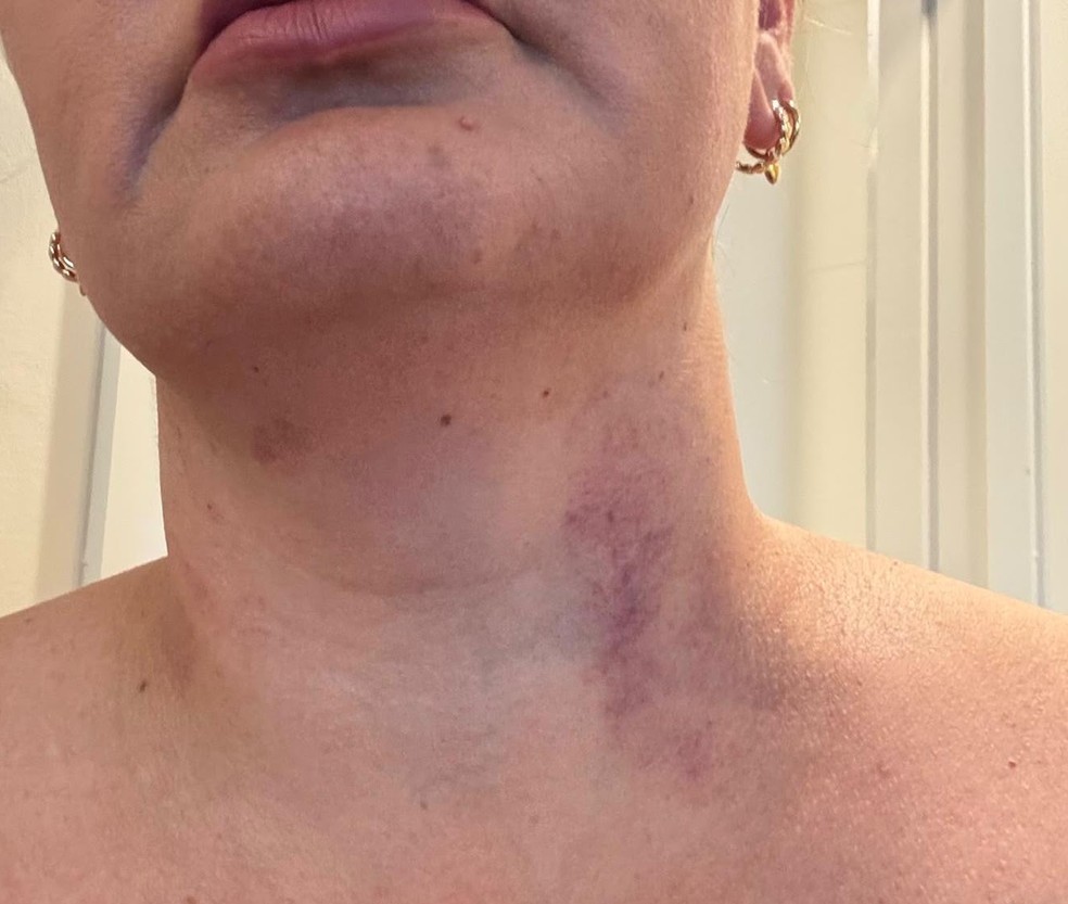 Purple bruise on the neck of the Brazilian woman who filed a complaint against Ryan Mendes — Photo: Personal Archive