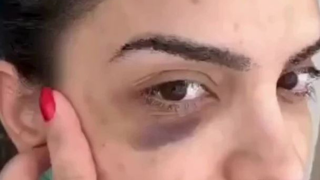 Natinha mostra hematoma causado por procedimento estético