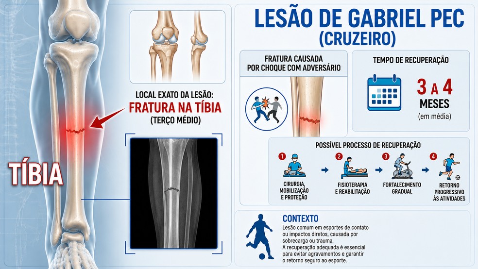 Infográfico explica onde foi a lesão de Gabriel Pec, do Cruzeiro — Foto: Infográfico/IA