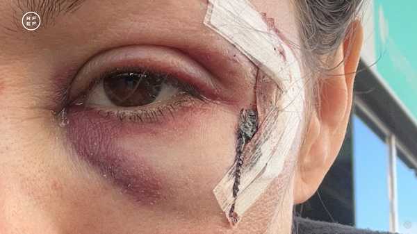 Terapia e 25 pontos: auxiliar volta ao futebol após grave choque com câmera | futebol espanhol