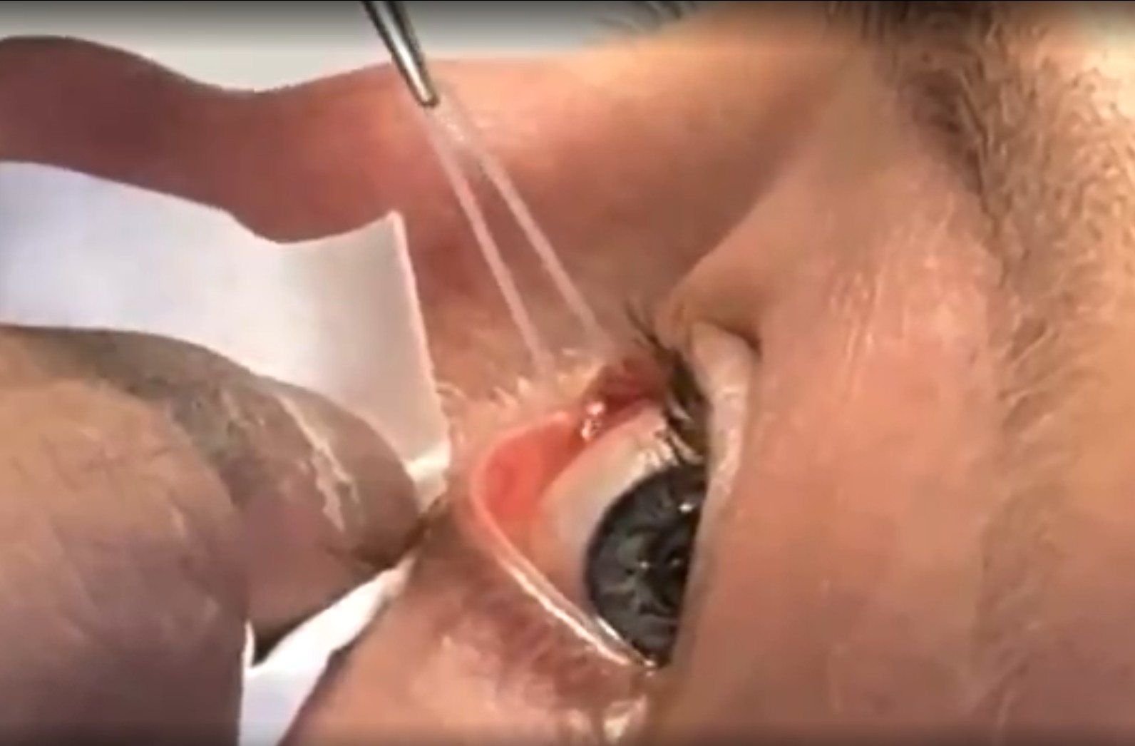 Rose Namajunas retira tubo do olho após cirurgia; veja o vídeo | Ge