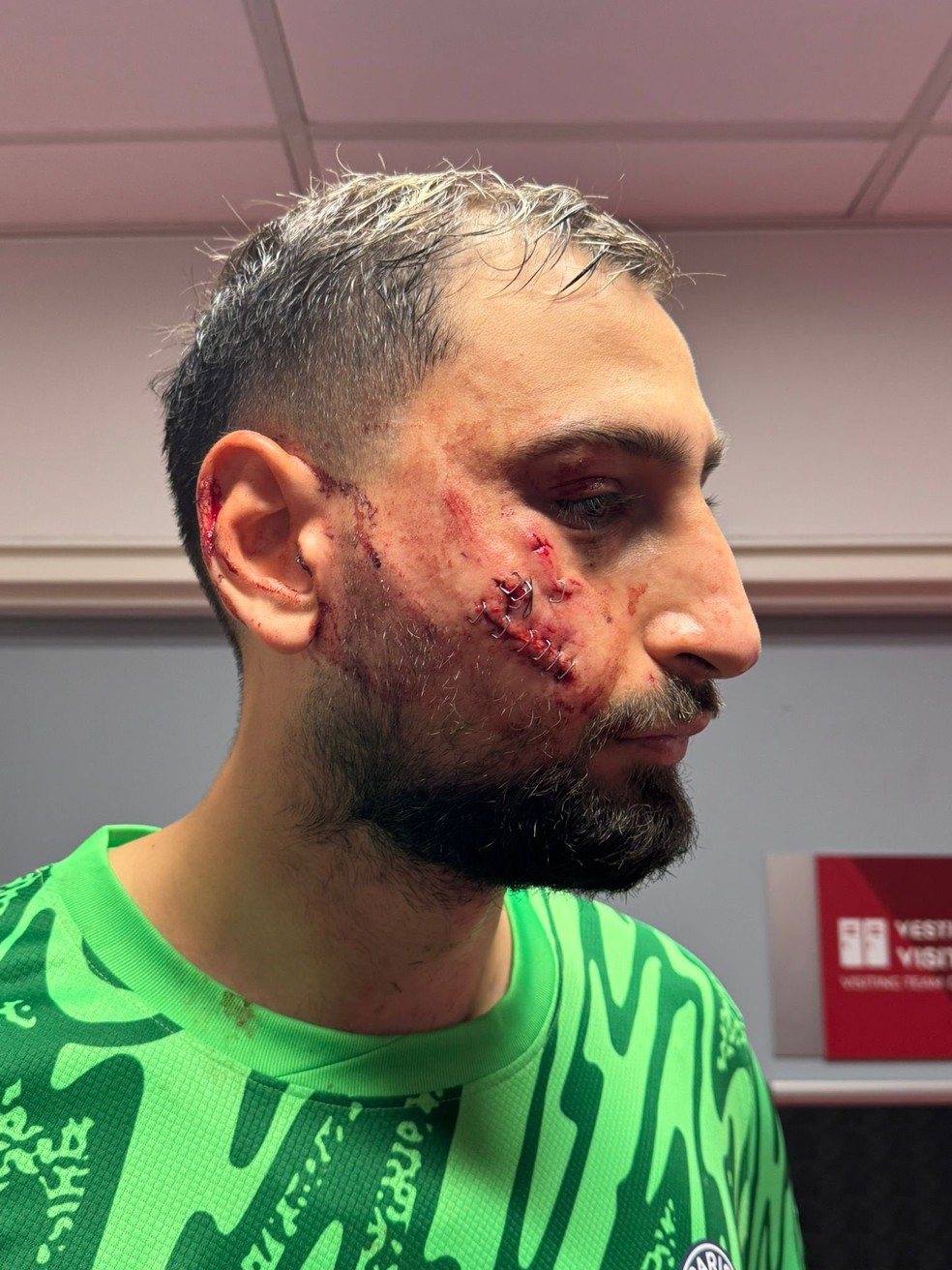 Goleiro Donnarumma precisou levar pontos no rosto após sofrer pisão na cara — Foto: Arthur Perrot / RMC Sport