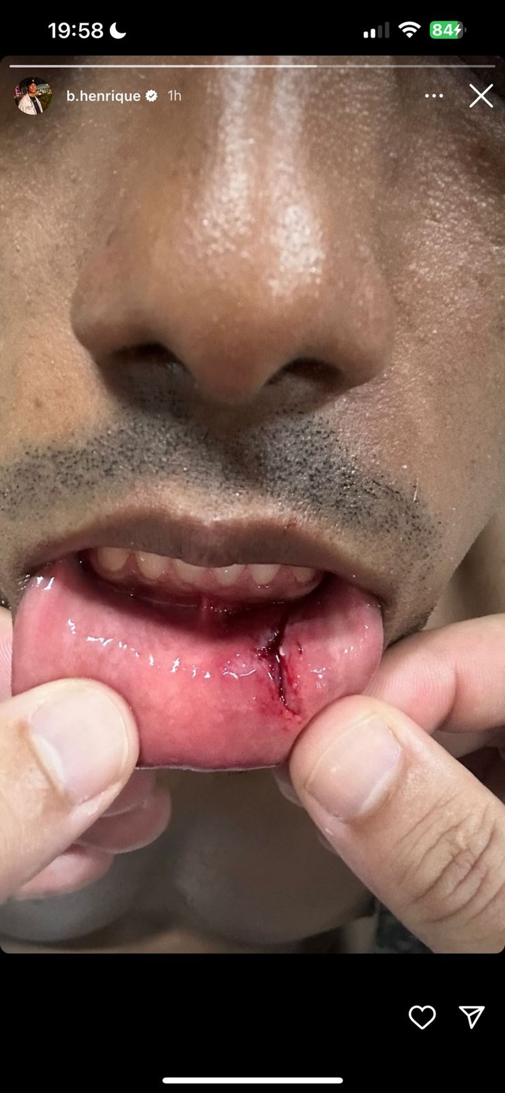 Bruno Henrique com corte na boca após Atlético-GO x Flamengo — Foto: Reprodução