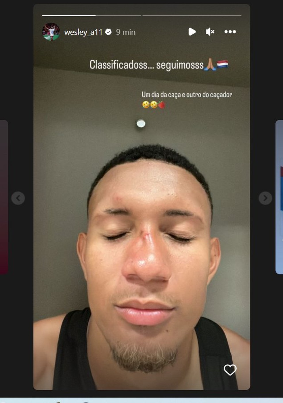 Atacante do Caxias sofre fratura no nariz após briga generalizada no  Beira-Rio