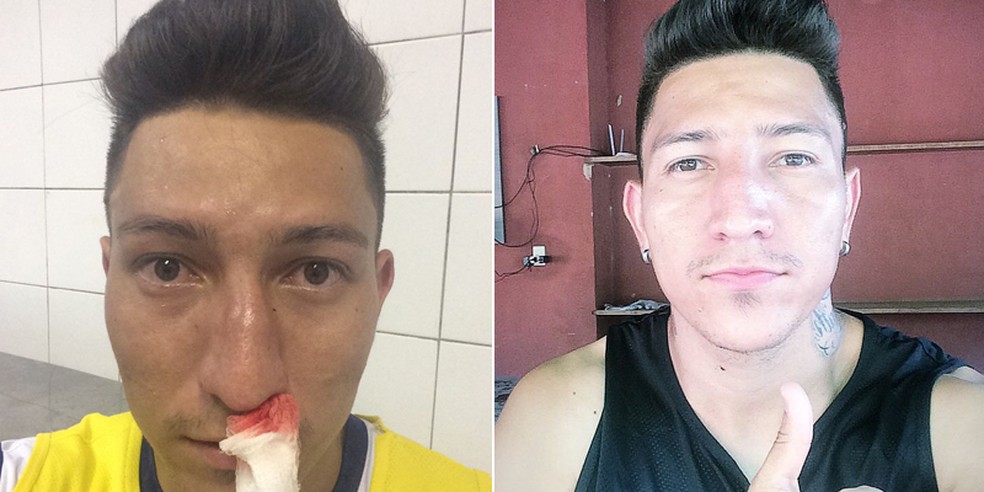 Pivô de pancadaria no Gauchão sofre fratura no nariz