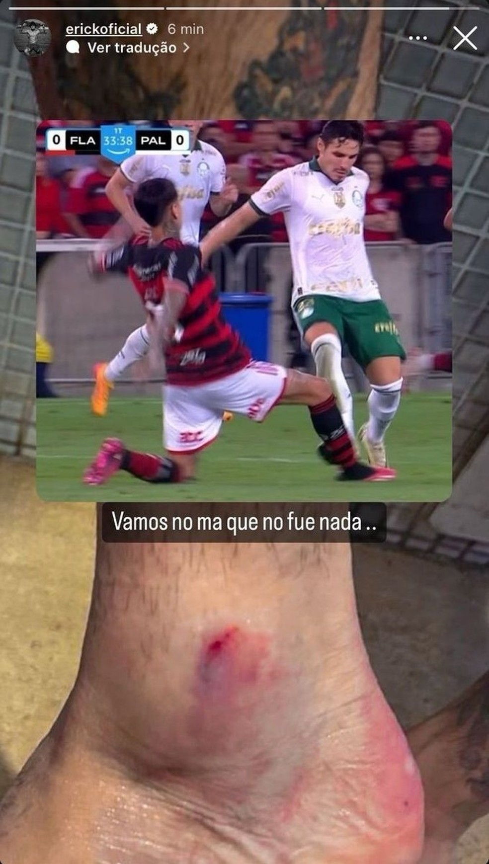 Pulgar posta foto de tornozelo após entrada de Veiga no Flamengo x Palmeiras — Foto: Reprodução