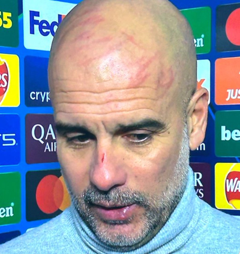 Pep Guardiola com um corte no nariz e arranhões na cabeça — Foto: Reprodução
