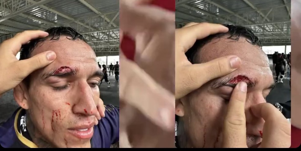 Charles do Bronx cortou o supercílio direito e ficou fora do UFC 294 — Foto: Reprodução/Instagram