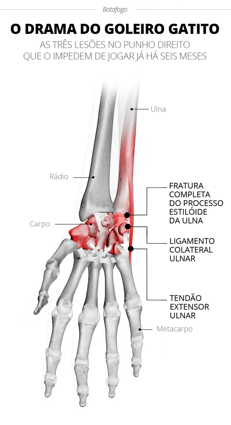 processo estilóide ulnar