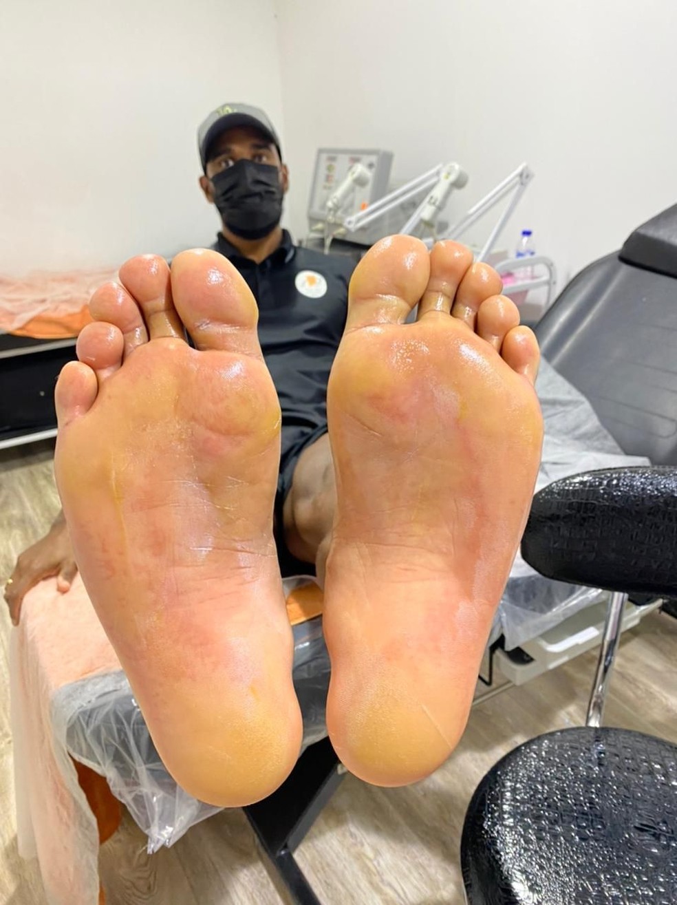 Luiz Antonio com os pés queimados nos Emirados Árabes em 2021 — Foto: Arquivo Pessoal