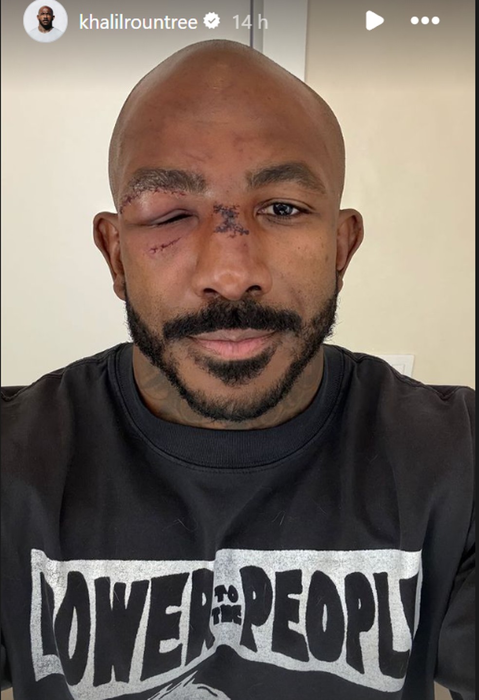 Khalil Rountree Jr. mostra rosto após luta com Poatan — Foto: Reprodução/ Instagram