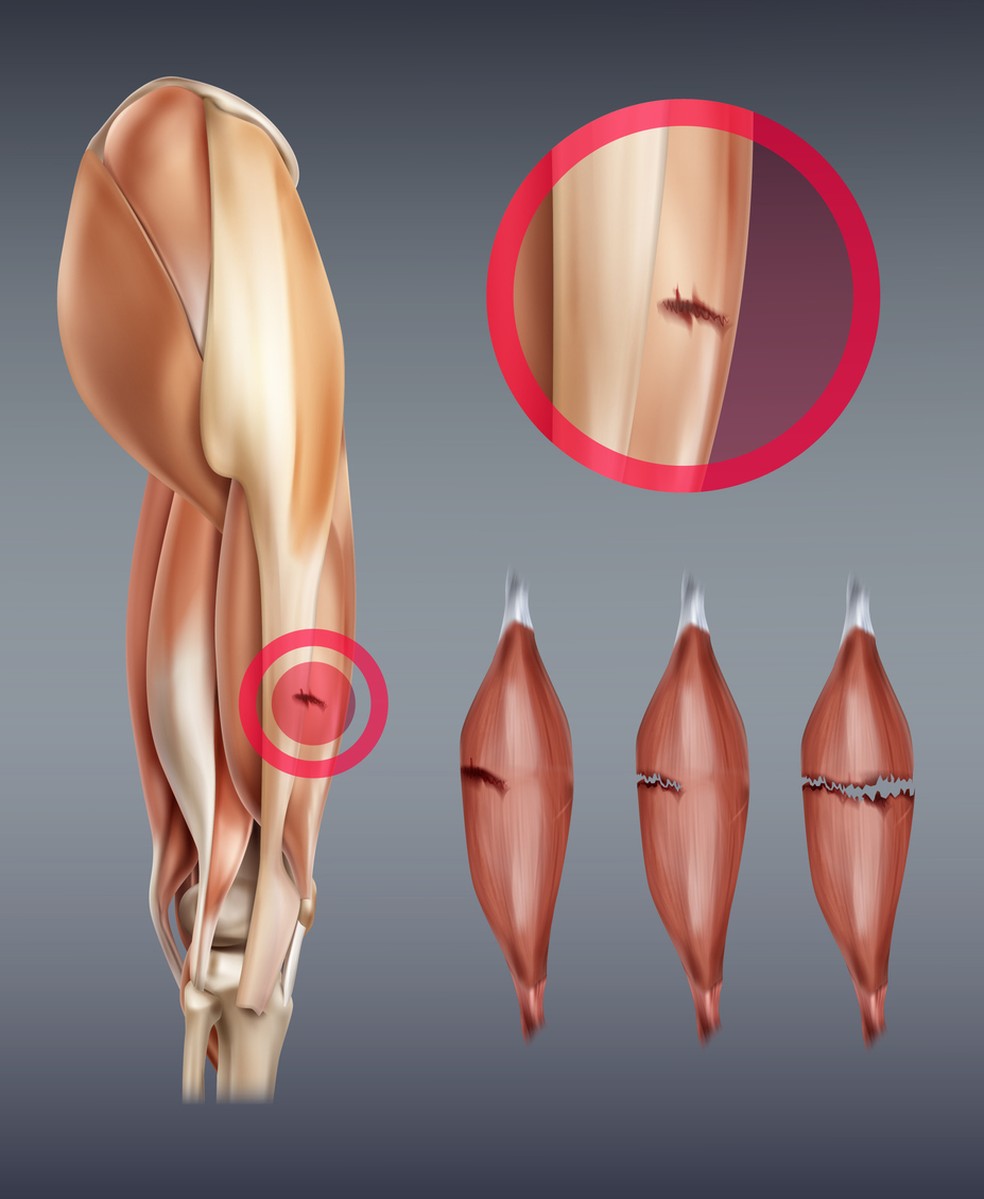 Ruptura das células musculares pode liberar substâncias tóxicas na corrente sanguínea, causando rabdomiólise — Foto: Istock Getty Images
